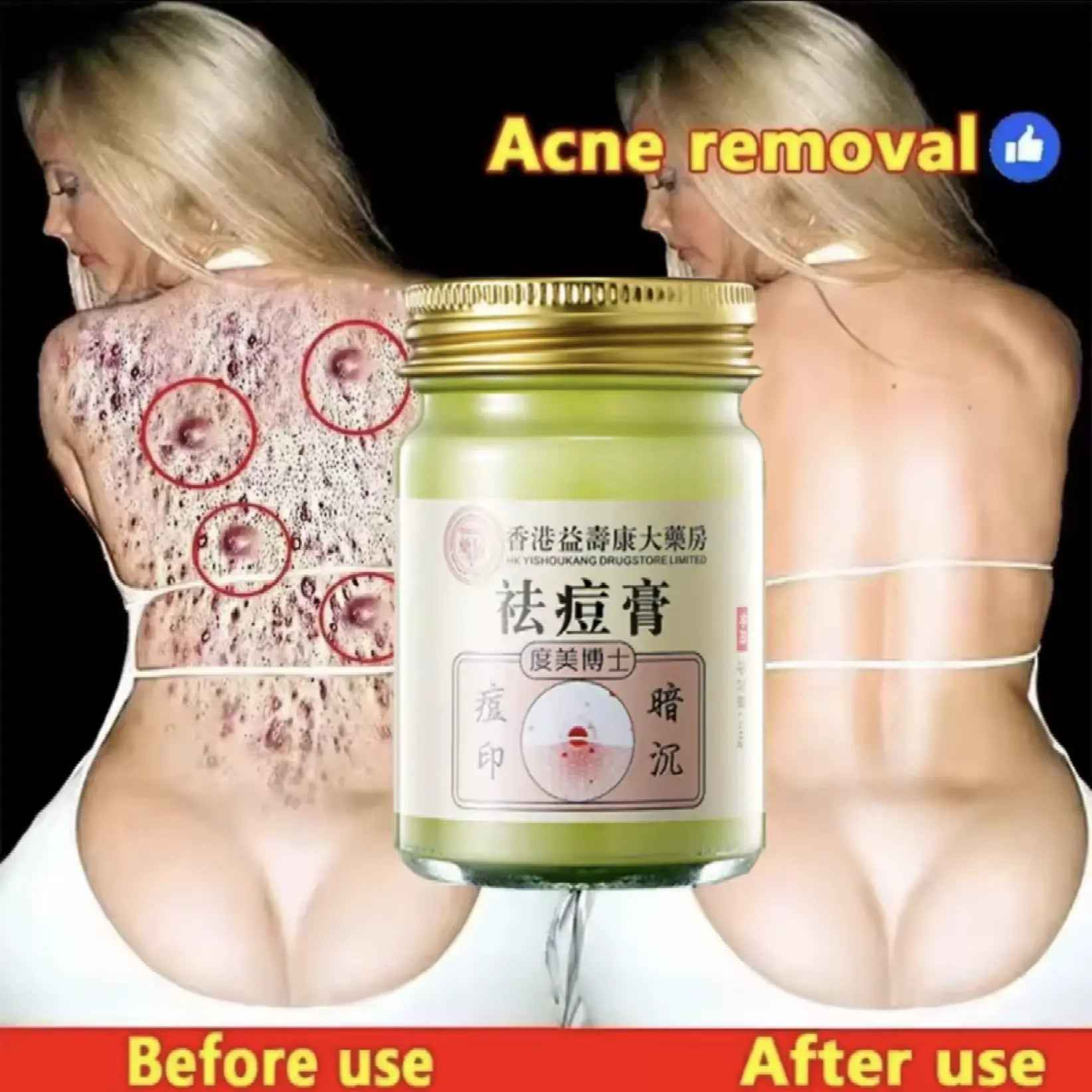 Body Acne Removal Cream Treatment Face Butt Back Acne Marks Smooth Repair