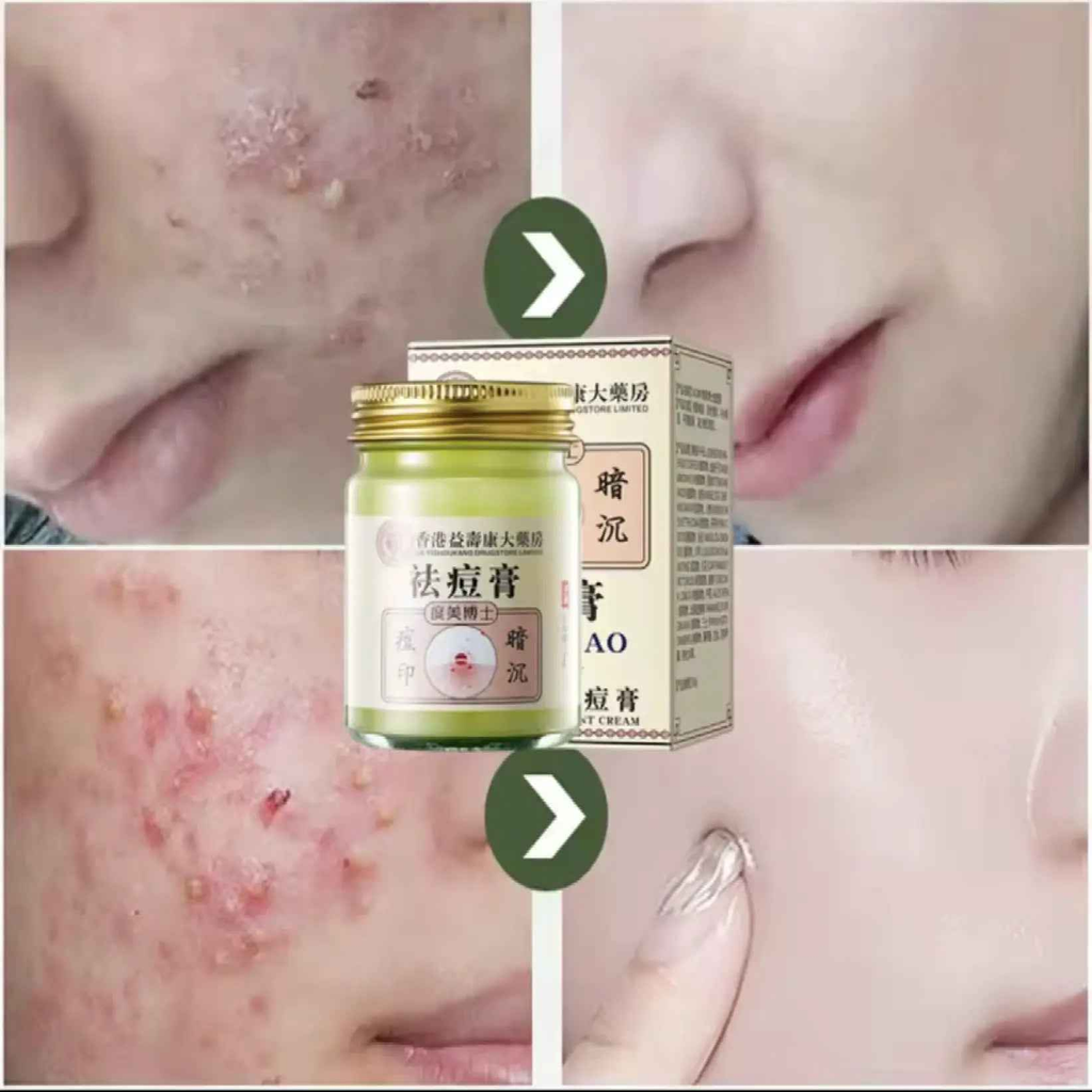 Body Acne Removal Cream Treatment Face Butt Back Acne Marks Smooth Repair