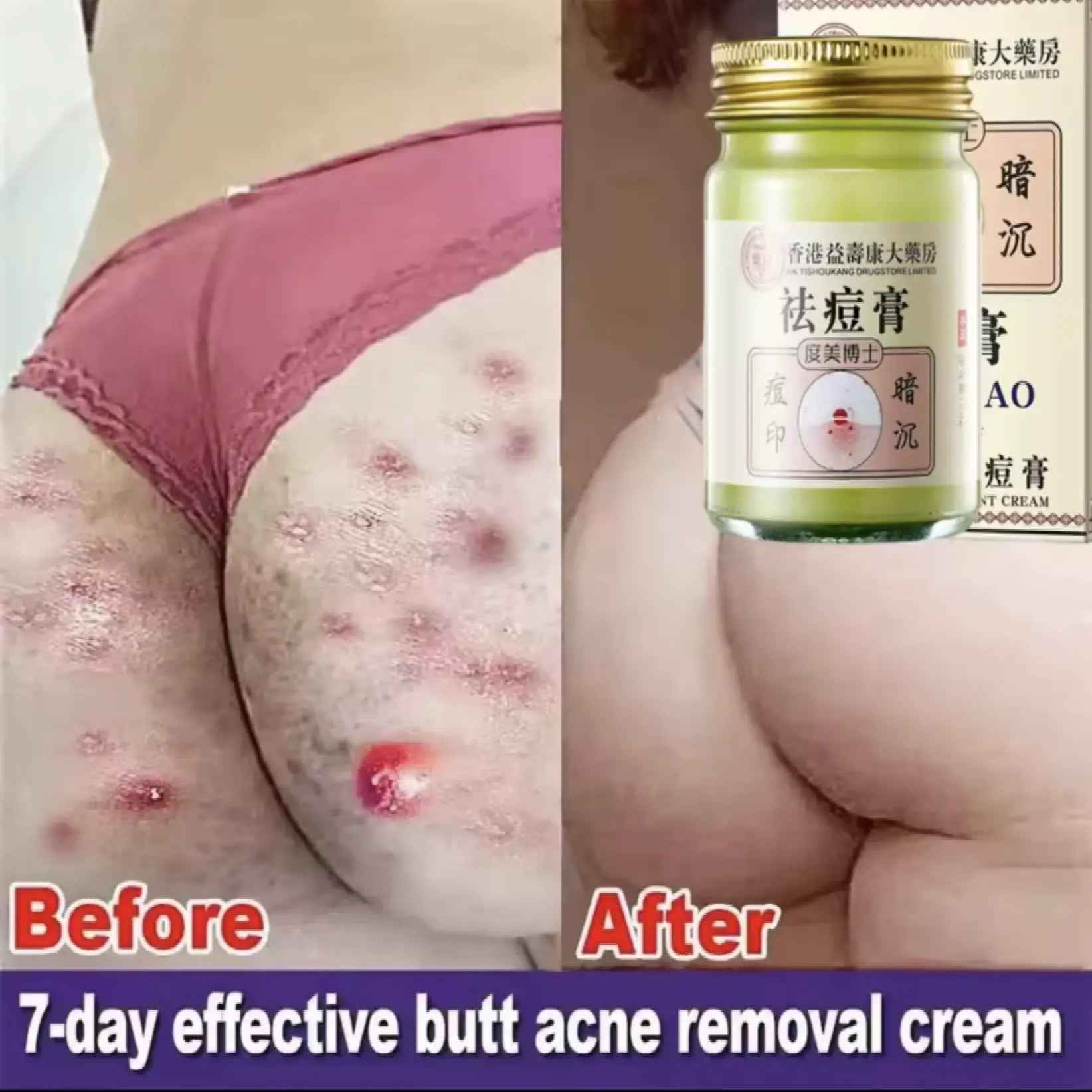 Body Acne Removal Cream Treatment Face Butt Back Acne Marks Smooth Repair