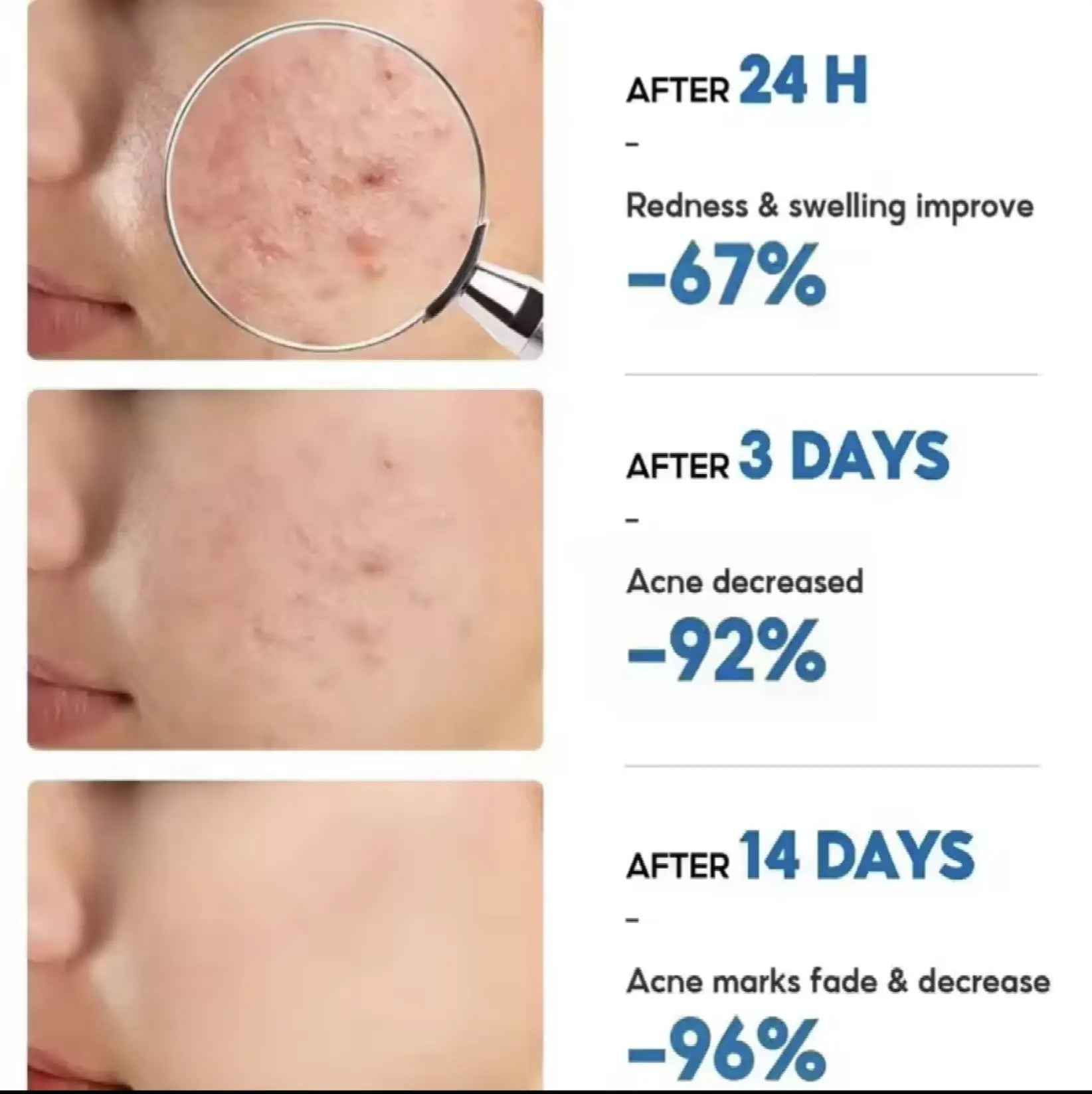 Body Acne Removal Cream Treatment Face Butt Back Acne Marks Smooth Repair